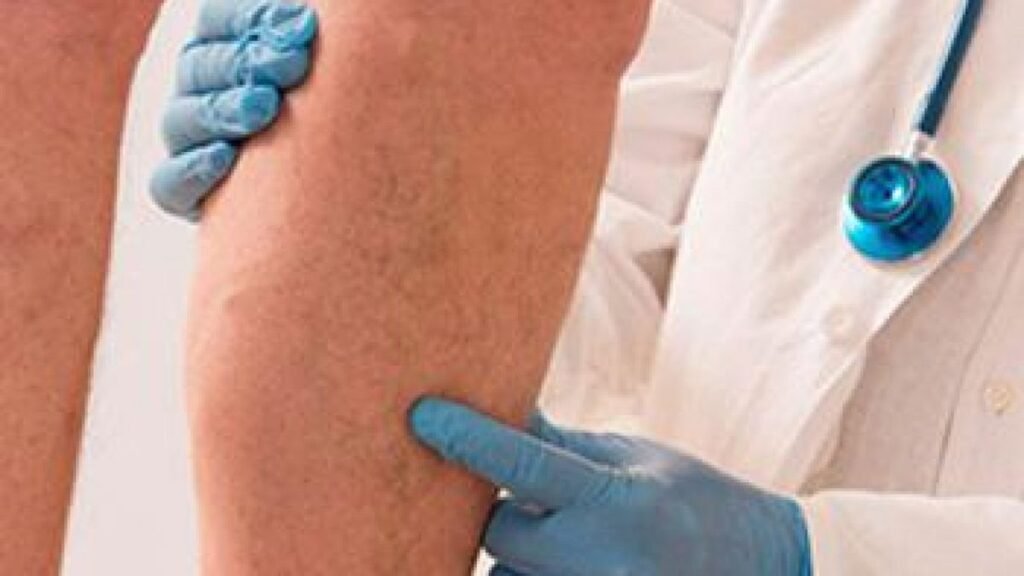 what is chronic venous insufficiency
